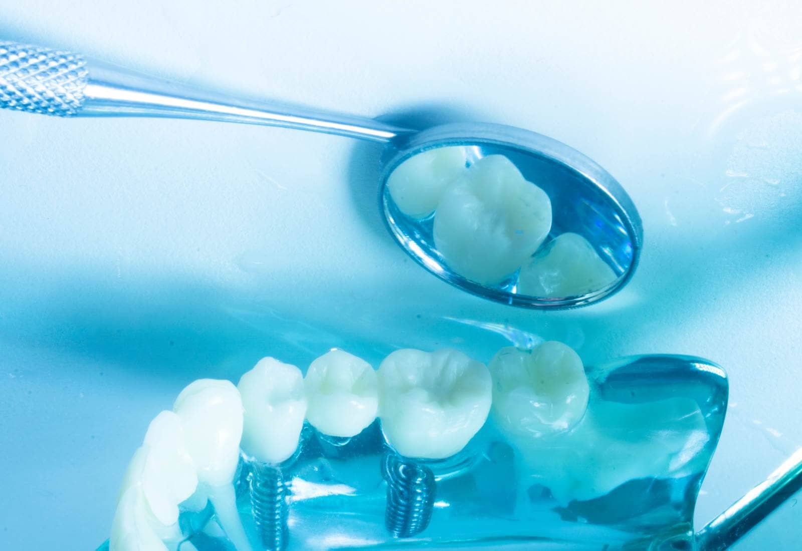 verificare cu oglinda a implantului dentar pe macheta stomatologica