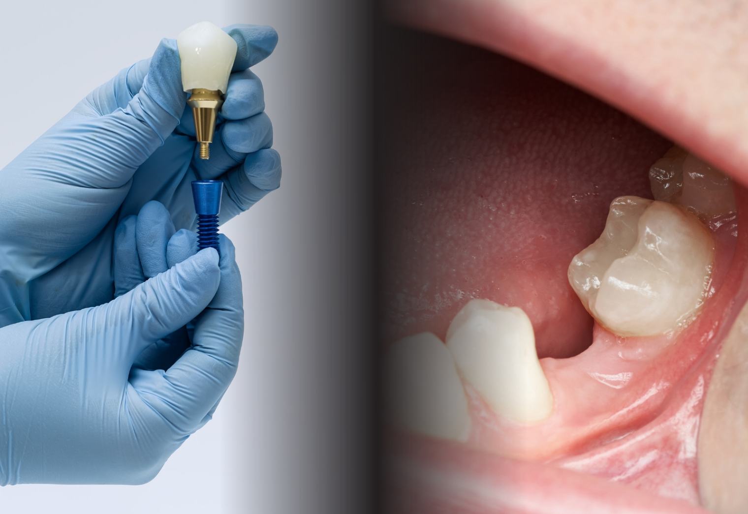 riscuri implant dentar